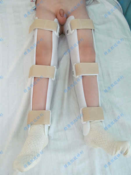 X- 型腿2